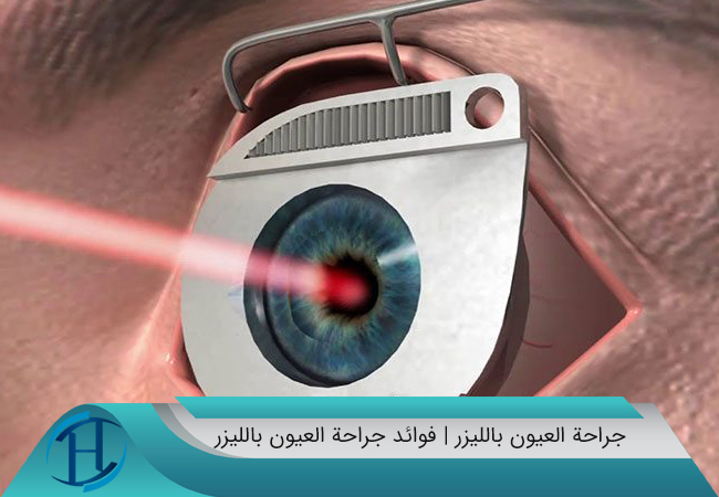 فوائد جراحة العيون بالليزر