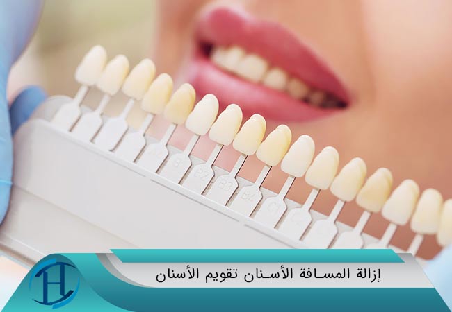 إزالة المسافة الأسنان تقويم الأسنان