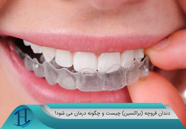 دندان  قروچه و درمان دندان قروچه