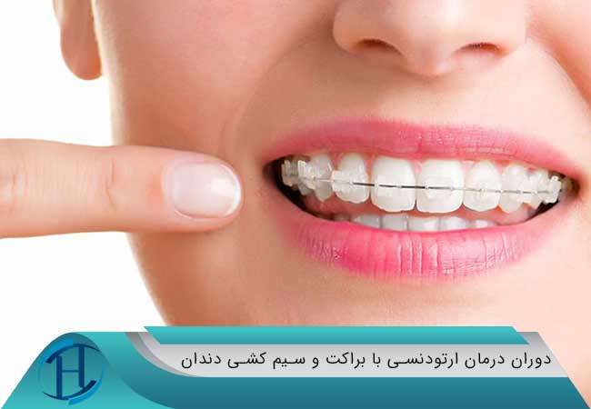 دوران درمان ارتودنسی با براکت و سیم کشی دندان