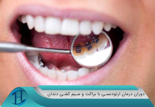 دوران درمان ارتودنسی با براکت و سیم کشی دندان