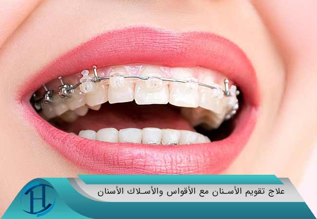 علاج تقويم الأسنان مع الأقواس والأسلاك الأسنان