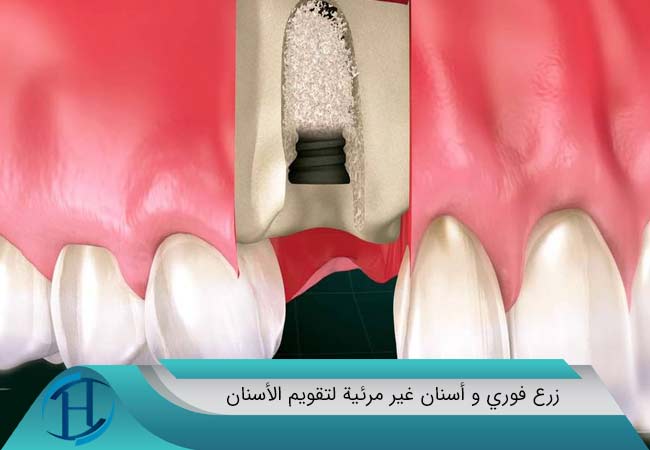 زرع فوري و أسنان غير مرئية لتقويم الأسنان