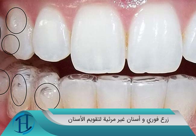 زرع فوري و أسنان غير مرئية لتقويم الأسنان