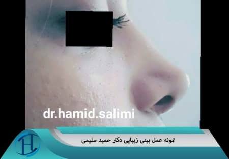 عمل زیبایی بینی دکتر سلیمی 