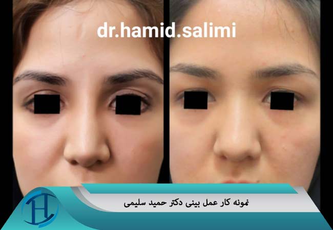نمونه کار جراحی بینی دکتر سلیمی مشهد